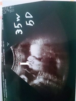 不妊治療を経て、検診の時。