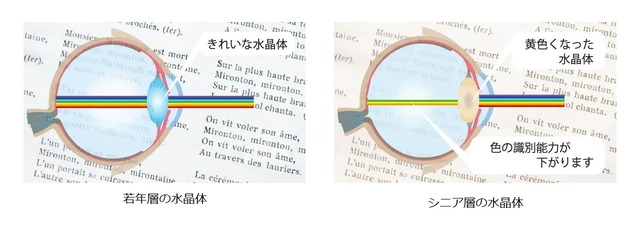 黄色くなった水晶体