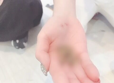 【闇深】地下アイドルさん、罰ゲームで食用コオロギを食べさせられる→アレルギー発症し入院