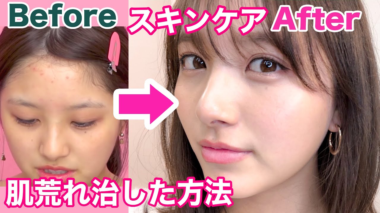【動画】大和田南那「私が肌荒れ改善した方法！ニキビゼロを維持する今のスキンケア」【実体験】