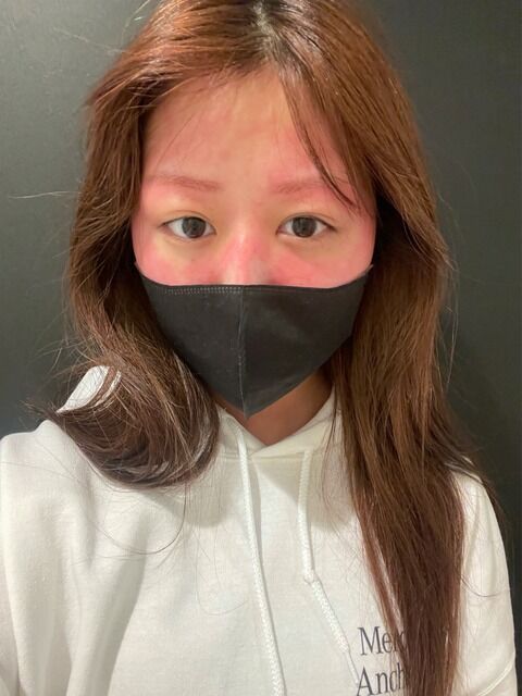 【衝撃】 吉橋柚花さん、眉毛を染めてアレルギーでとんでもない顔になる・・・