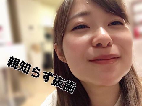 指原、抜歯で顔面崩壊wwwwwwwww