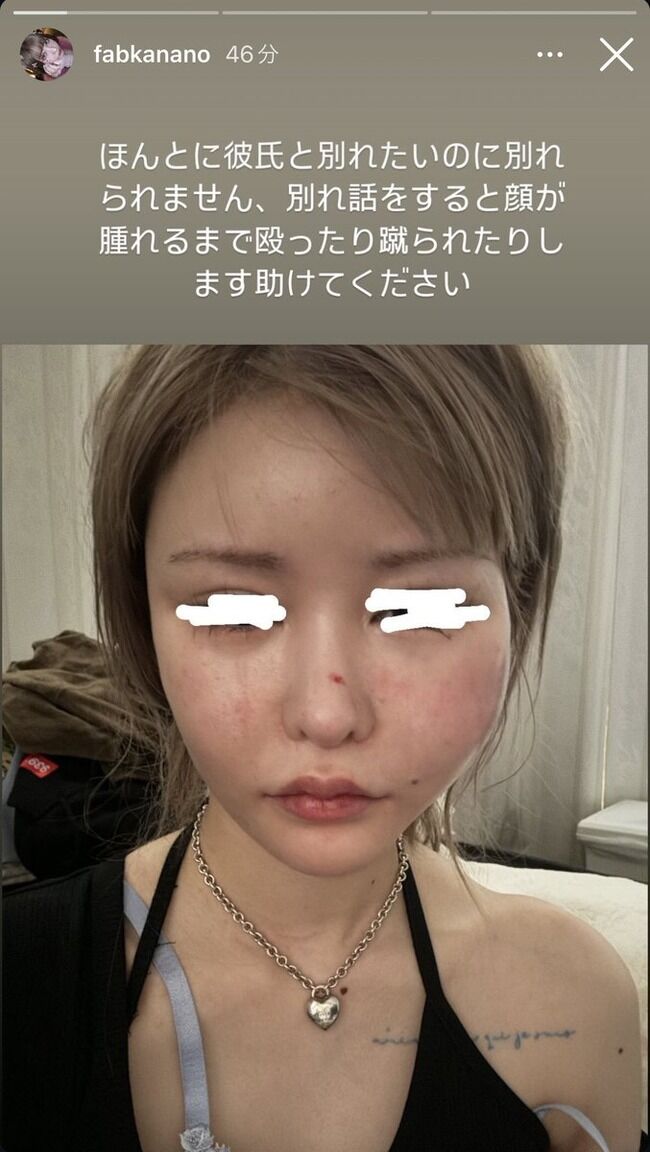 【闇深】戦慄かなのの顔面が腫れ上がるほど殴るDV、交際相手レペゼンDJまるが逮捕・・・