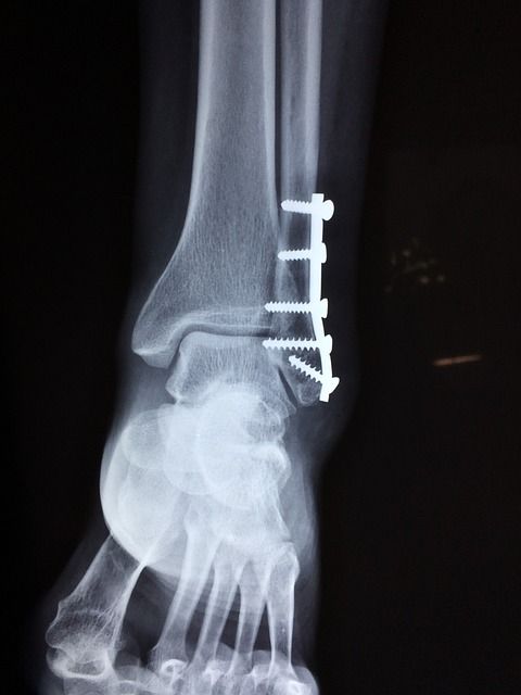 ankle-2253057_640