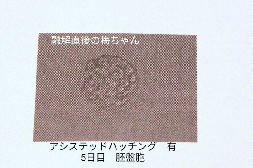 Bt5移植後の体調とここまでのまとめ 体外受精日記 あんずの休日