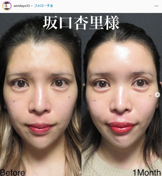 坂口杏里全身整形ビフォーアフター