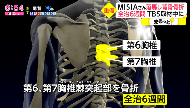 松本伊代、TBS「オオカミ少年」の落とし穴で腰椎の圧迫骨折