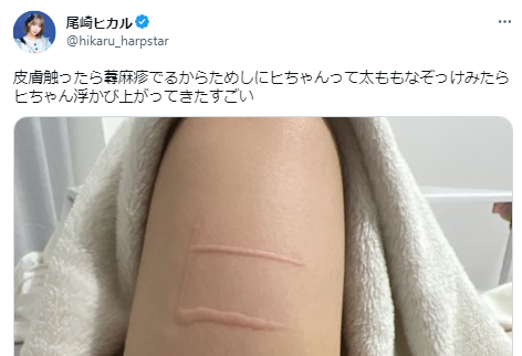 【画像】美少女アイドルが衝撃投稿・・・皮膚を触ったら蕁麻疹が出るからと太ももをなぞって文字を書いてしまう【尾崎ヒカル】