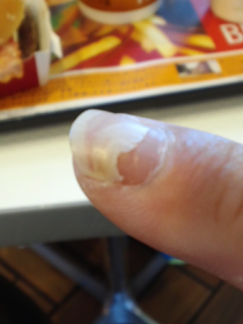 手足口病と戦った傷跡www クマの呟き