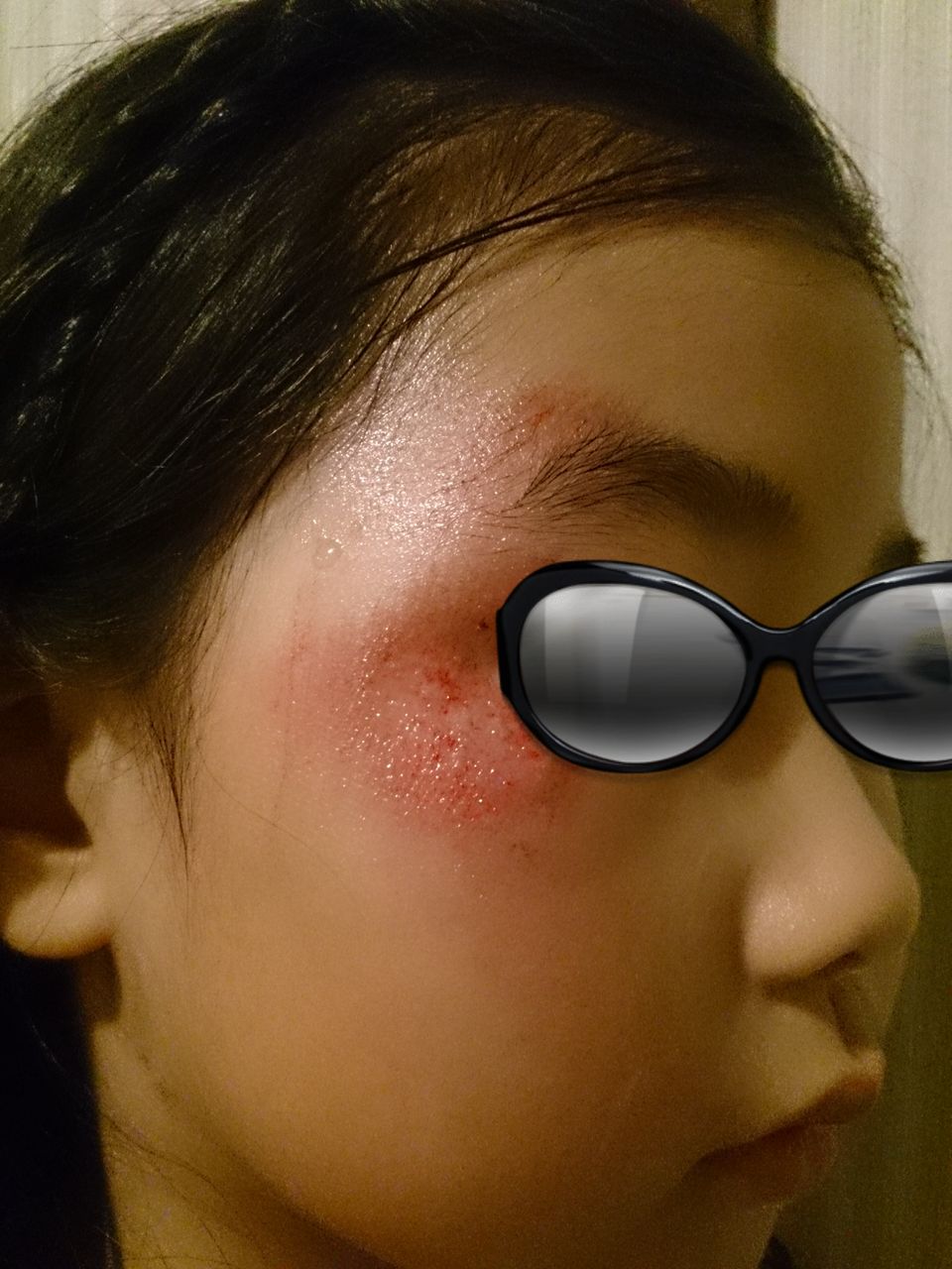 傷の治りを早くするフィブラストスプレーは高級品ｗ Ako S Voice