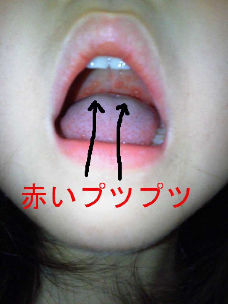 ヘルパンギーナの症状 治療 対策 画像でちゅ Ako S Voice ヘルパンギーナの症状 治療 対策 画像でちゅ Ako S Voice