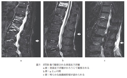 fracture-MRI