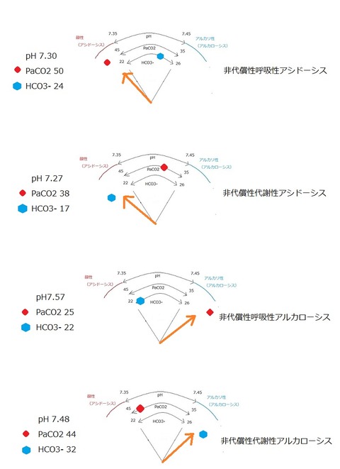 血液ガスの見方 代償①