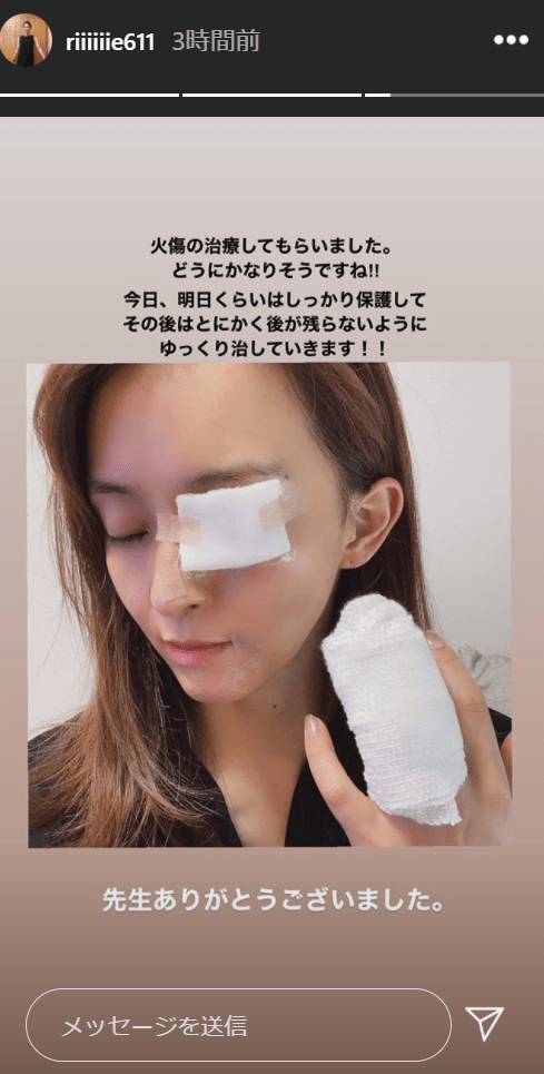 田中理恵さん 顔面と指をやけどした痛々しい姿に心配の声 油が顔に飛んでしまい 田中理恵 アラフィフ生活のblog 田中理恵さん 顔面と指をやけどした痛々しい姿に心配の声 油が顔に飛んでしまい 田中理恵 アラフィフ生活のblog