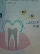 ☆酸蝕歯その2 ☆