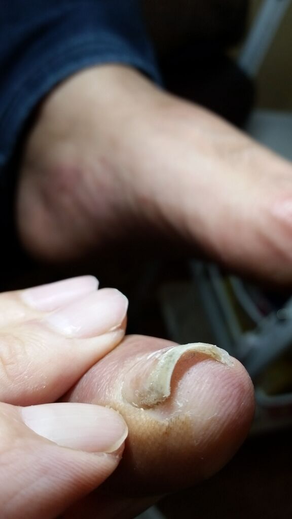 その痛みは爪の棘ではありませんか 巻き爪 外反母趾 フットケア専門 クリアプラス 長崎 ひととき 島原 その痛みは爪の棘ではありませんか 巻き爪 外反母趾 フットケア専門 クリアプラス 長崎 ひととき 島原