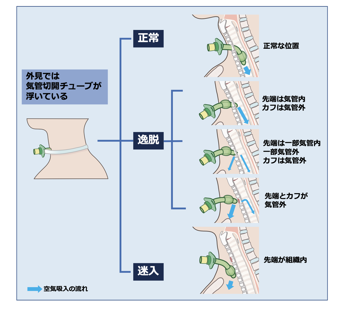 Icu備忘録 集中治療