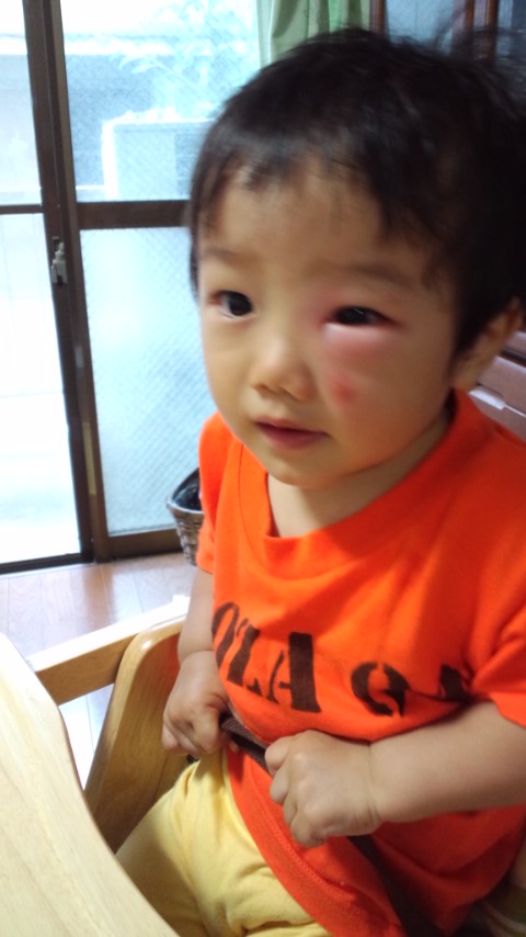 目が腫れると オキナワaサインバーkoza マスターtakuの企み 目が腫れると オキナワaサインバーkoza マスターtakuの企み
