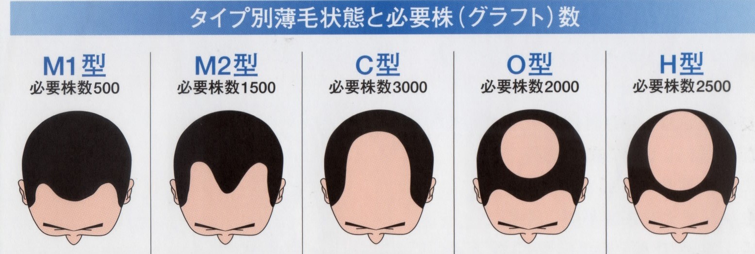 禿げる前 ハゲとかだっせーからハゲたら剃ってスキンヘッドにするわwww ムドリク速報 おーぷん2chまとめ
