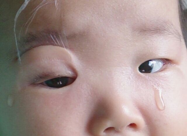 眼瞼下垂 眼瞼下垂日記 心配性短気母ちゃんのblog