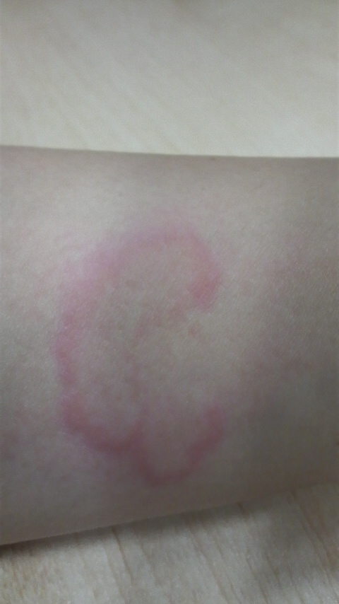 蕁麻疹の発症 アスリートママblog