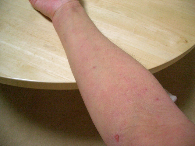 アトピー闘病記録