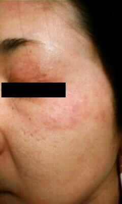 アトピー闘病記録