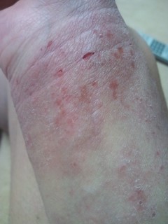 アトピー闘病記録