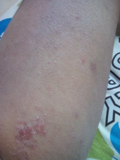 アトピー闘病記録