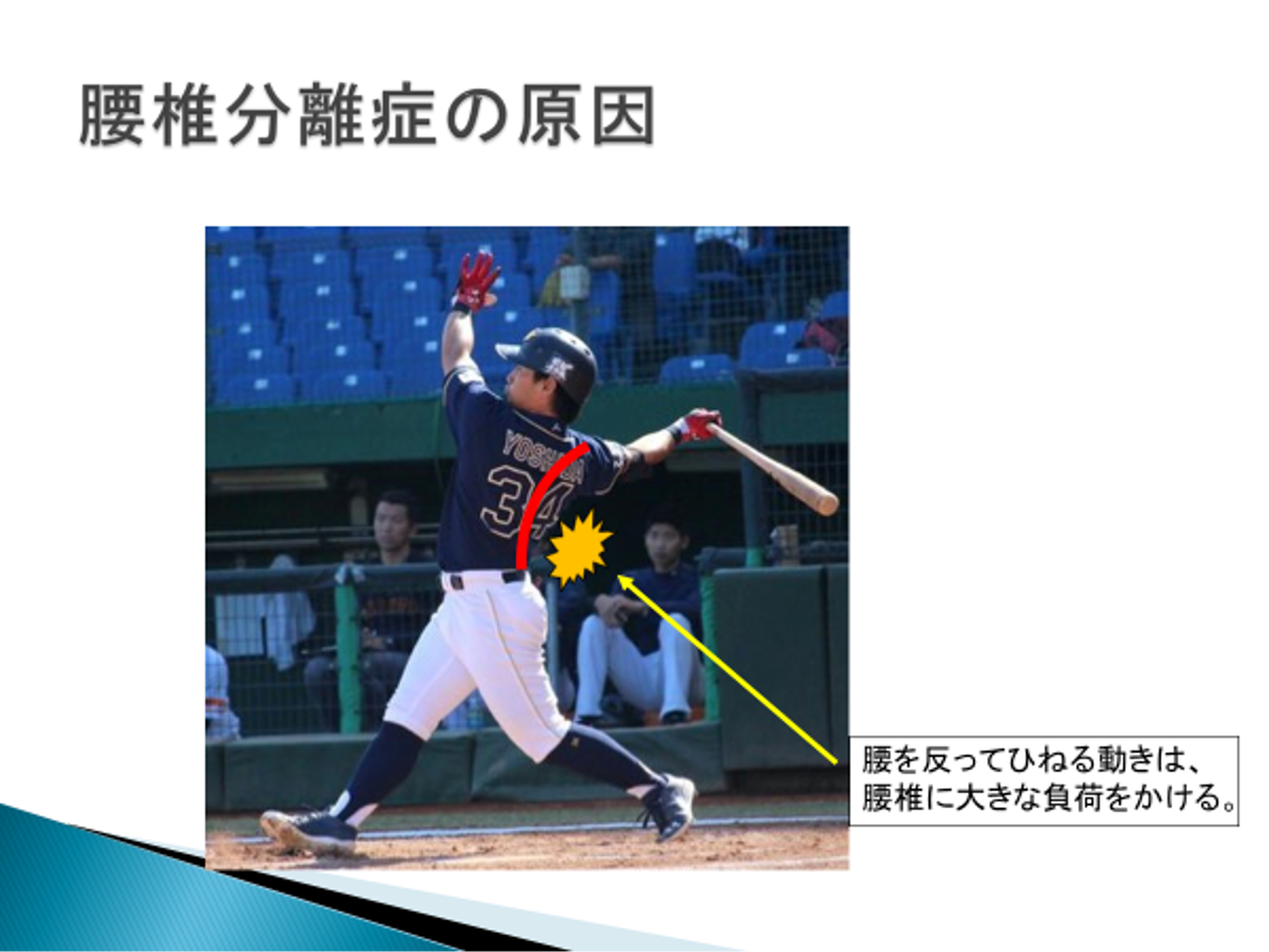 腰椎分離症は長期休養が必要か 科学的根拠のある説明 Med野球 野球のトレーニングと治療についてー