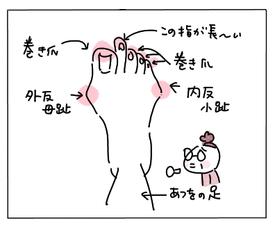 外反母趾1