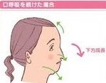 口呼吸の弊害 画像1