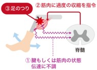 足の攣りメカニズム 画像1