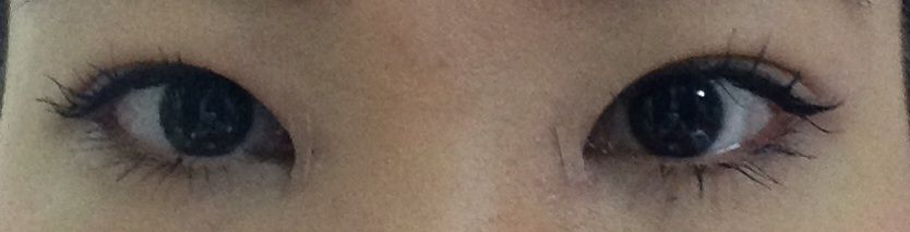 目頭切開 W 経過