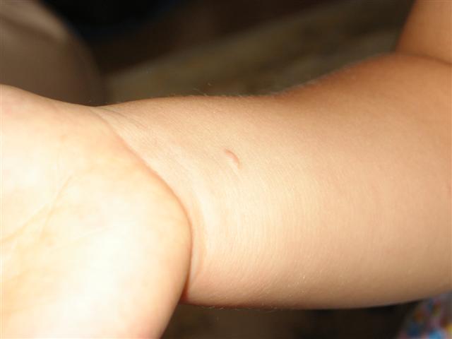 幼児教育でドレミな毎日 水いぼの治療