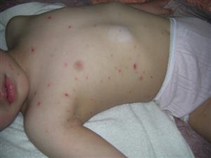 幼児教育でドレミな毎日 水疱瘡 経過