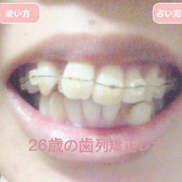 上だけ装着 ガタガタ前歯 26歳の歯列矯正レポ 美しい口元をgetするまで 上だけ装着 ガタガタ前歯 26歳の歯列矯正レポ 美しい口元をgetするまで
