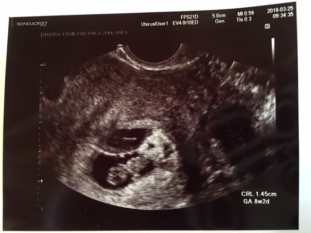 8ｗ2ｄ 出血後の生活態度と胎嚢の形が三角は良くない話 多嚢胞性卵巣と糖尿病とベビ待ちブログ