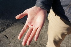 InjuredPalm151220