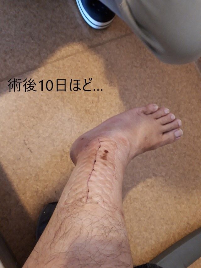 骨折した場所が毛深くなる 痛い画像注意 バイクで遊びつくそう 骨折した場所が毛深くなる 痛い画像注意 バイクで遊びつくそう