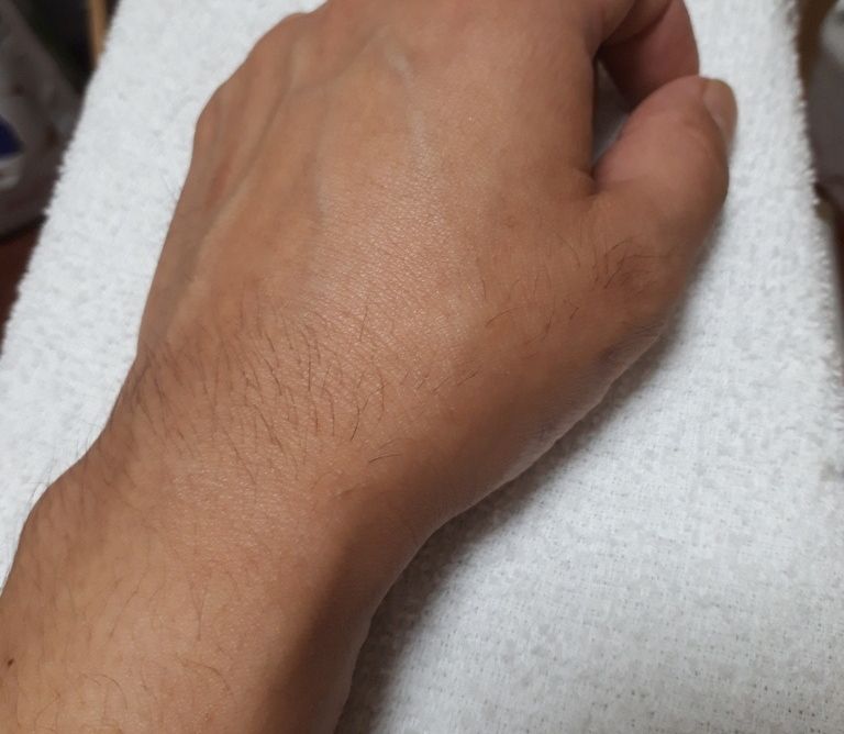 骨折した場所が毛深くなる 痛い画像注意 バイクで遊びつくそう 骨折した場所が毛深くなる 痛い画像注意 バイクで遊びつくそう
