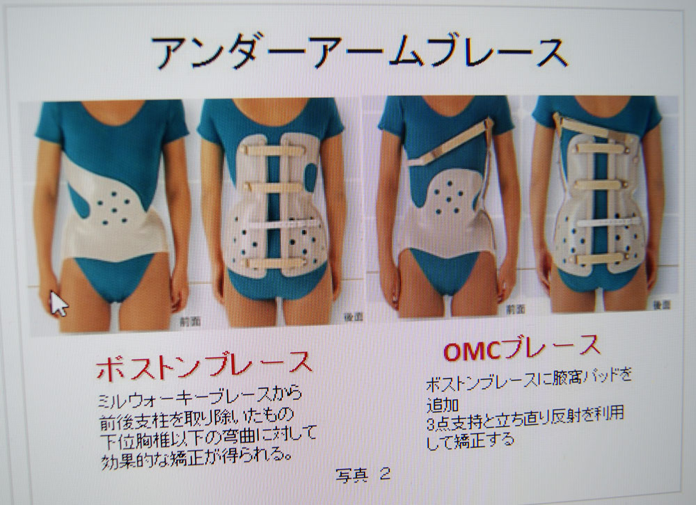 □「側弯症」 一宮のお医者さんより。 : 人体解剖学など。