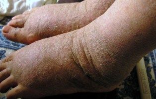 脱ステ直後のリバウンド地獄と10ヵ月後の天国 そして第2リバウンドと湯治後の天国 アトピーと脱ステロイド奮闘記 脱ステ直後のリバウンド地獄と10ヵ月後の天国 そして第2リバウンドと湯治後の天国 アトピーと脱ステロイド奮闘記