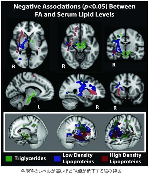 white matter change-4