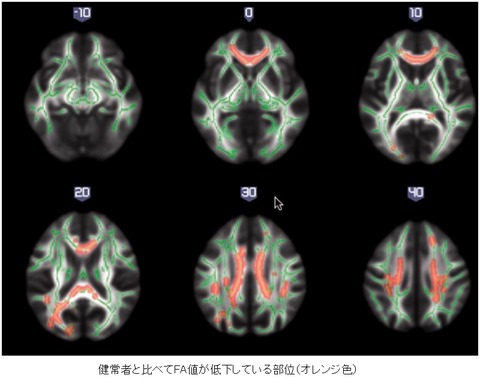 white matter change-8