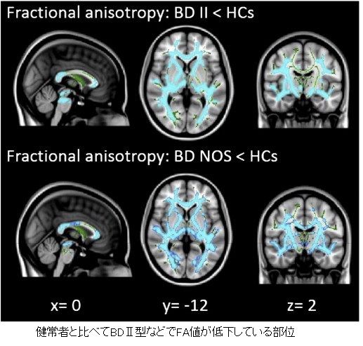 white matter change-10