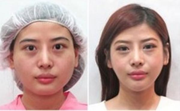 【台湾】「骨削り」の整形手術で小顔を手に入れた26歳女性、美女に生まれ変わる過程をネット公開…ネットユーザー「すごい！」と驚嘆 まとめたくない速報