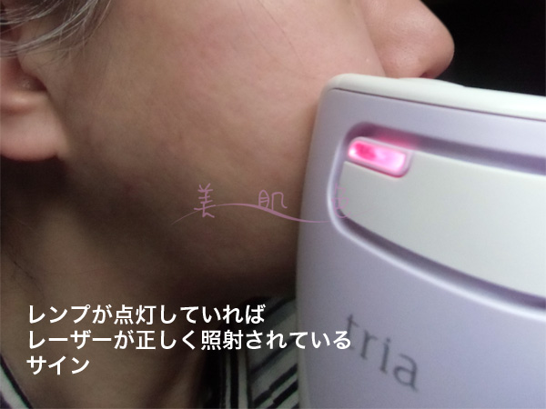 レーザー照射中