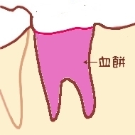 drysoketto2