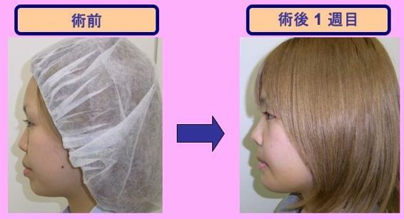 たるみ ほうれい線をなくす美容スレ18 美容2chまとめブログ